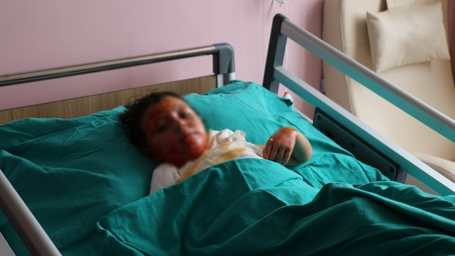 Halep’te soba yakarken yanan kardeşler Sivas’ta tedavi görüyor
